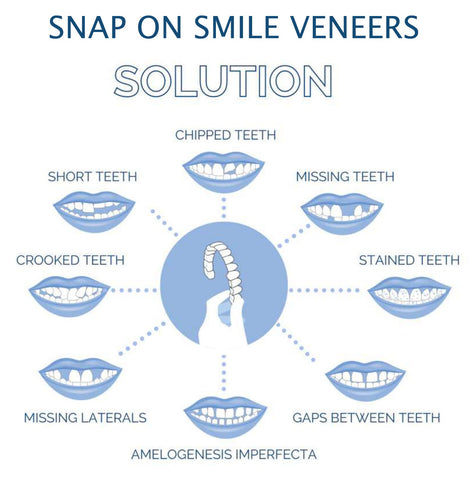 Snap-On Smile Veneers Set
